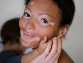 White-Patches-On-Skin